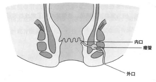 肛瘺